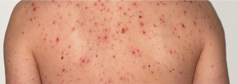 ROKOTTAMATTOMUUS EI SELITÄ TUHKAROKKOEPIDEMIOITA